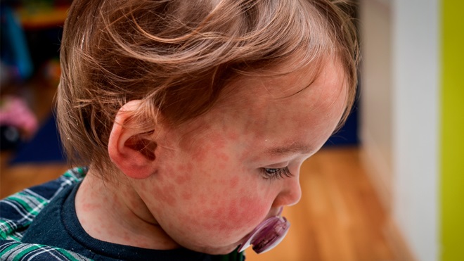 Enfant atteint de la rougeole